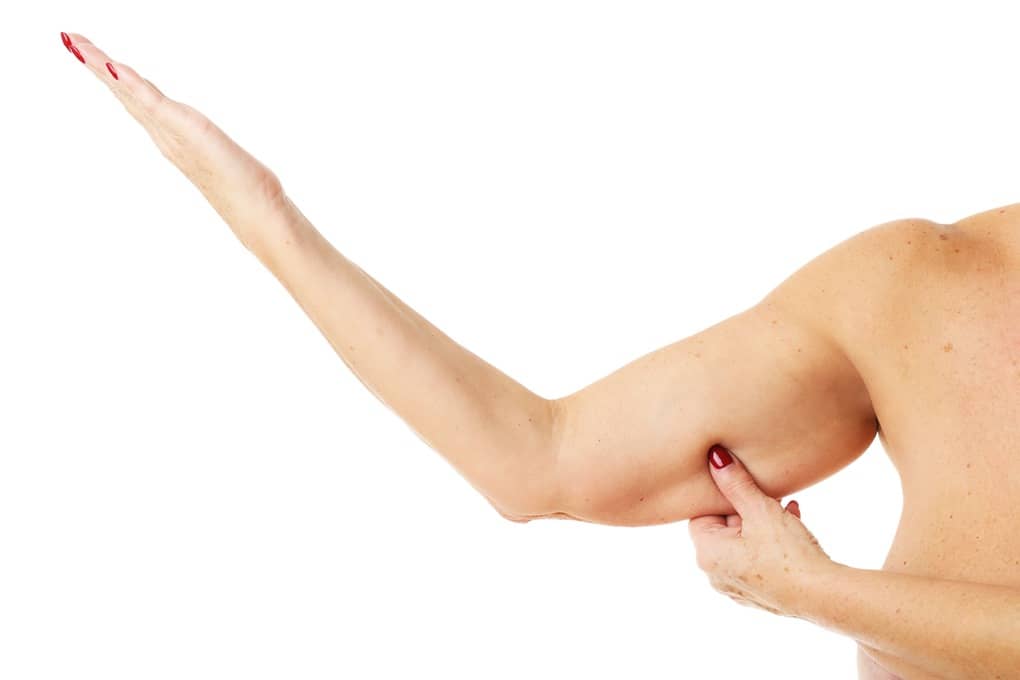 Process of Arm Liposuction Recovery 2 – arm liposuction recovery Picture of obese adult woman showing arm over white background