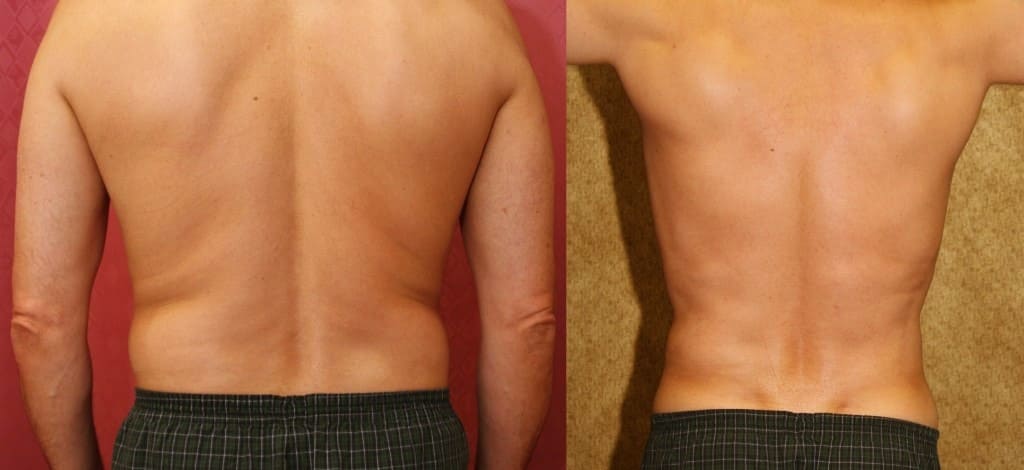 Liposuction to Lose Arm and Back Fat 1 – Liposuction to Lose Arm and Back Fat