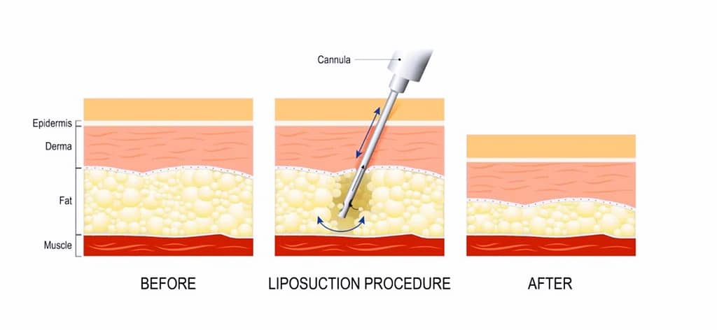 liposuction procedure. Before and after. fat modeling and surgery