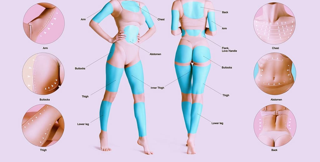 Finding a Smart Liposuction Provider Near You 1 – smart liposuction near me Smart Liposuction Near Me Chart