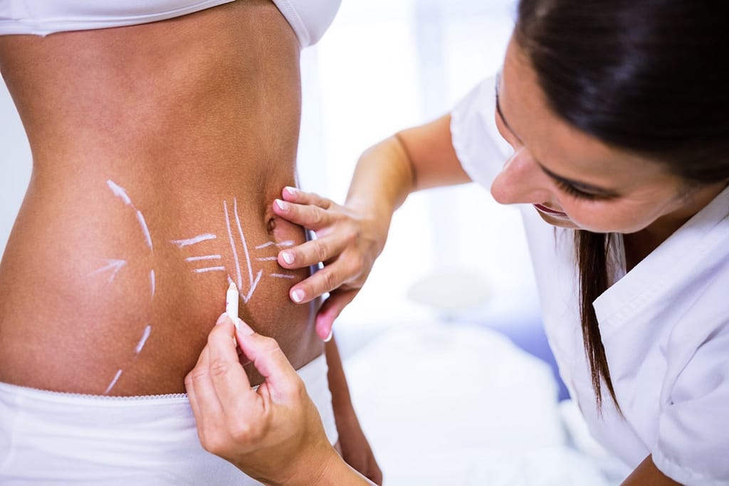 Close-up of surgeon drawing lines on womans abdomen for liposuction and tummy tuck removal