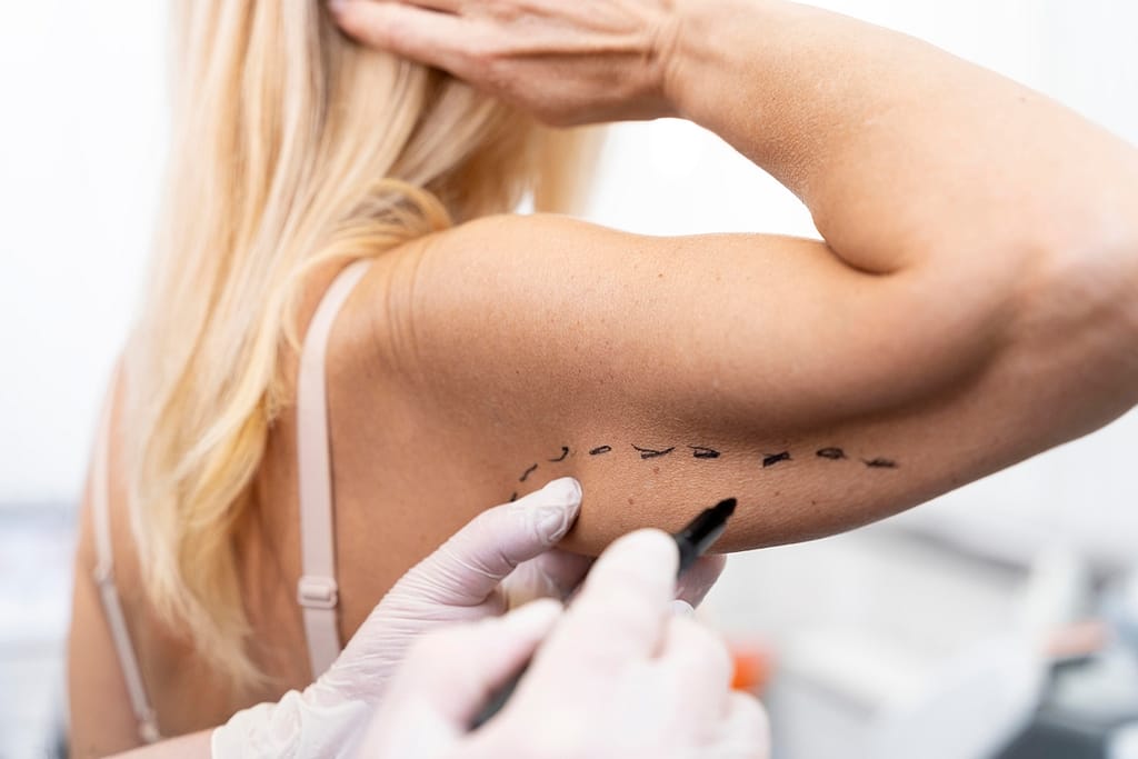 For those who want to permanently eliminate stubborn fatty deposits from their arms, liposuction on arms is an option.