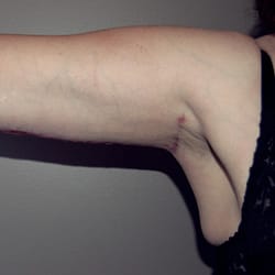 What Happens to Arm Liposuction Scars? 1 – arm liposuction scars Professional surgeon shares this ambition and makes use of the best equipment and methods to achieve this goal.