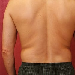Liposuction to Lose Arm and Back Fat
