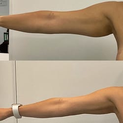 Under Arm Liposuction