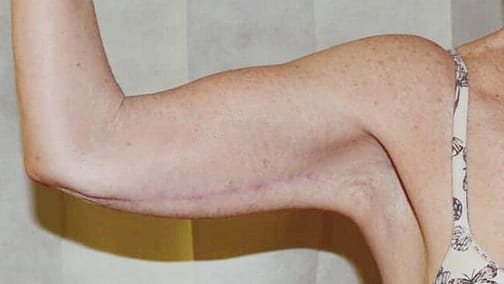 Arm body contouring Liposuction Scars