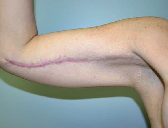 Arm liposuction may be a great option for these people. This is done by arm fat removal surgery.