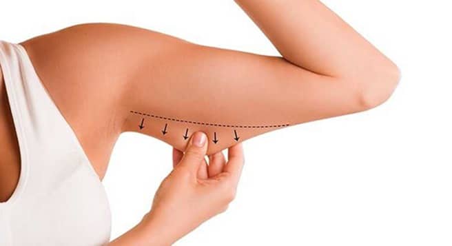 Experts of arm liposuction near me cordially encourage you to peruse our wide before and after gallery for arm liposuction.
