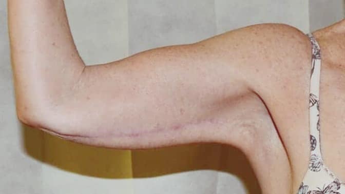 What Happens to Arm Liposuction Scars? 1 – arm liposuction scars Arm body contouring Liposuction Scars