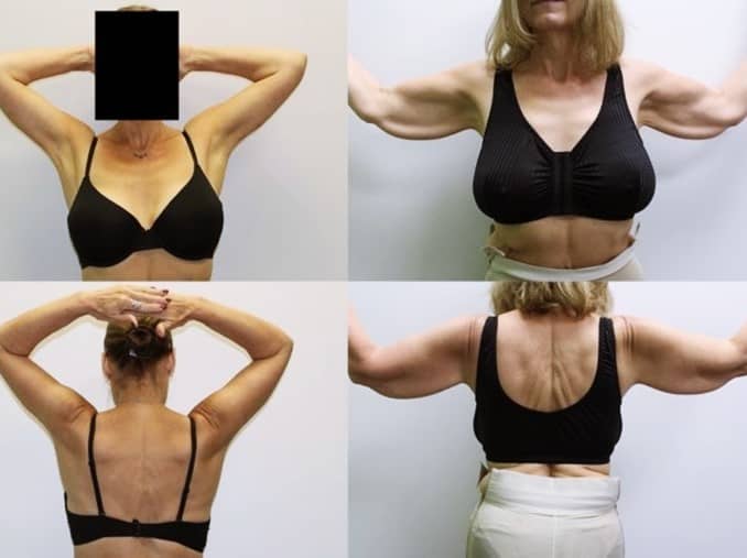 Arm Lift realistic expectations