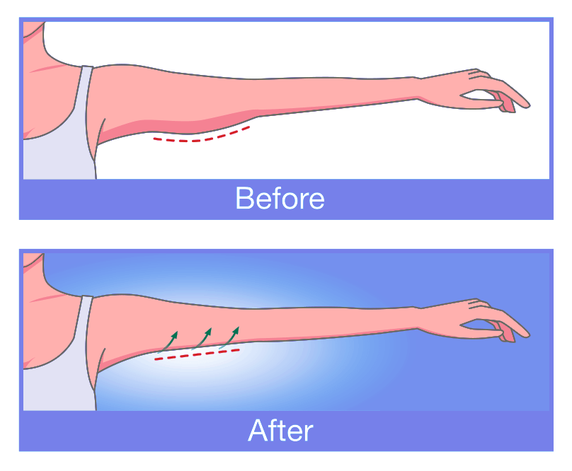 your upper arms or arm liposuction scars