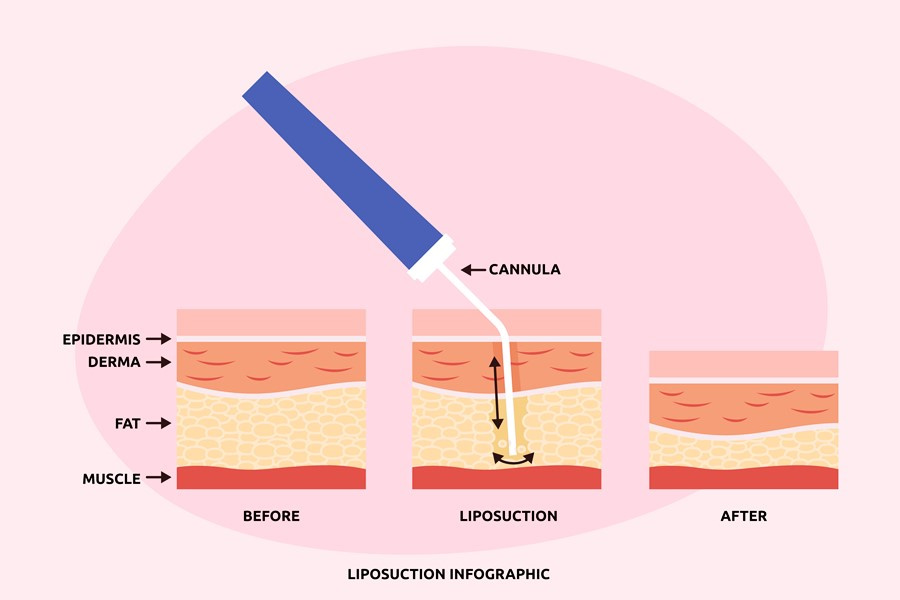 liposuction infographic