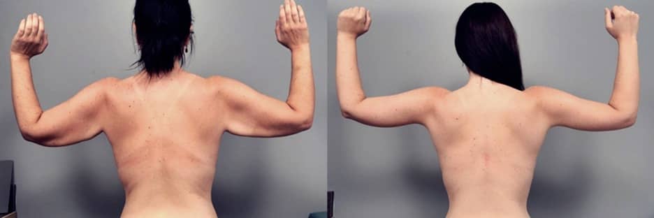 arm lift liposuction before & after
