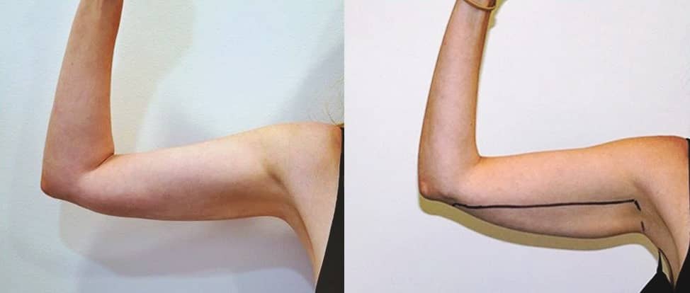 Arm liposuction technology also has the ability to preserve connective tissue and burn fat
