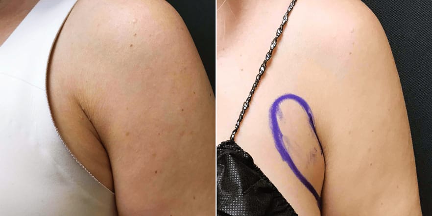 armpit fat bra fat caucasian female rightside after 3 months new jersey