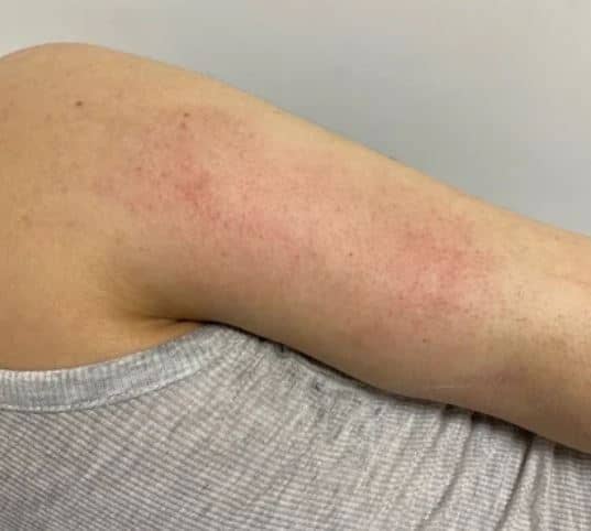Botched arm lipo , is it possible to gain weight on my arms after liposuction with time