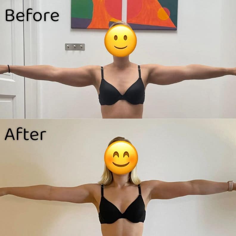 Arm Liposuction Review (10 months post-op)