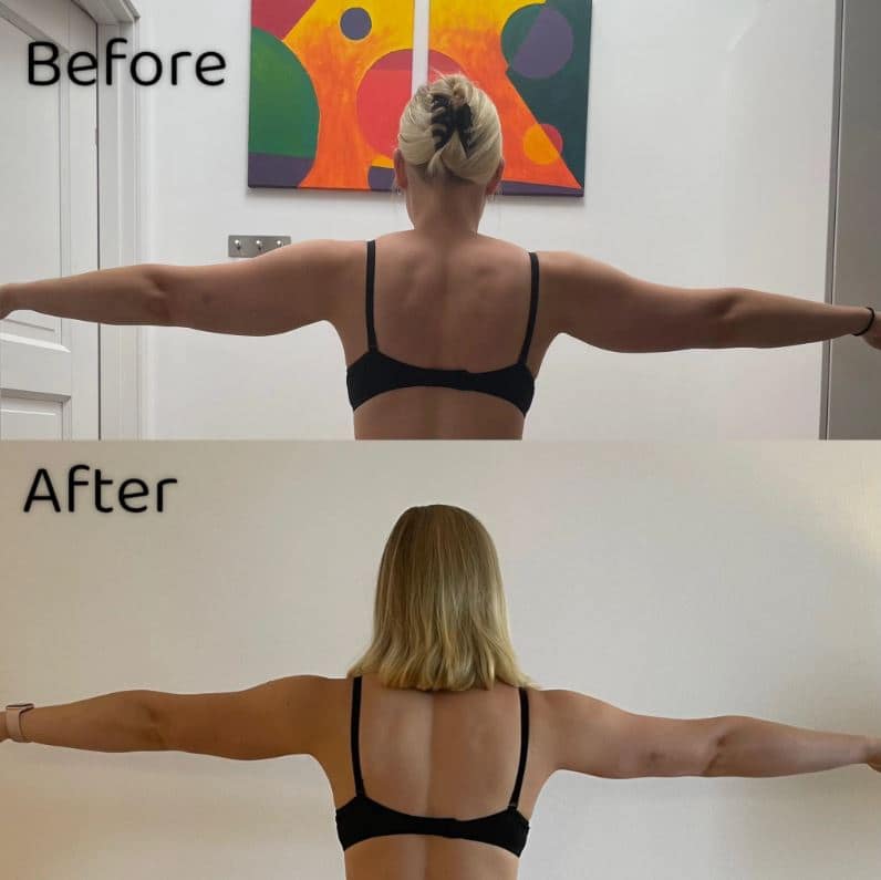 Arm Liposuction Review (10 months post-op) 2