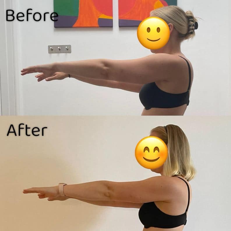 Arm Liposuction Review (10 months post-op) 3