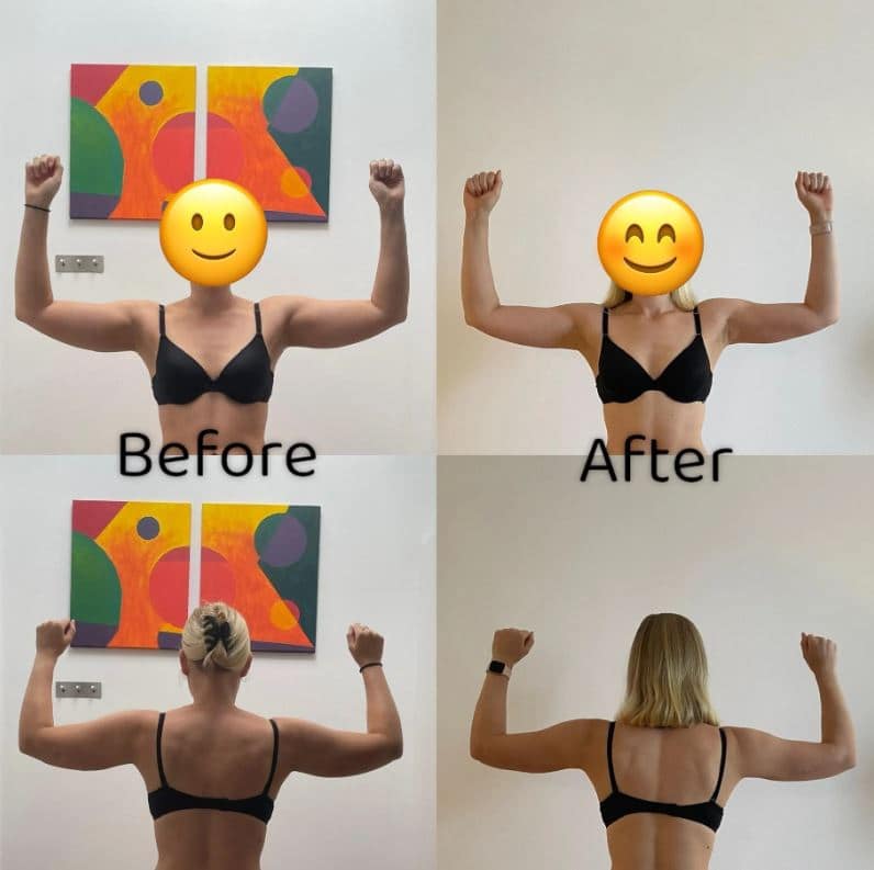 Arm Liposuction Review (10 months post-op) 4