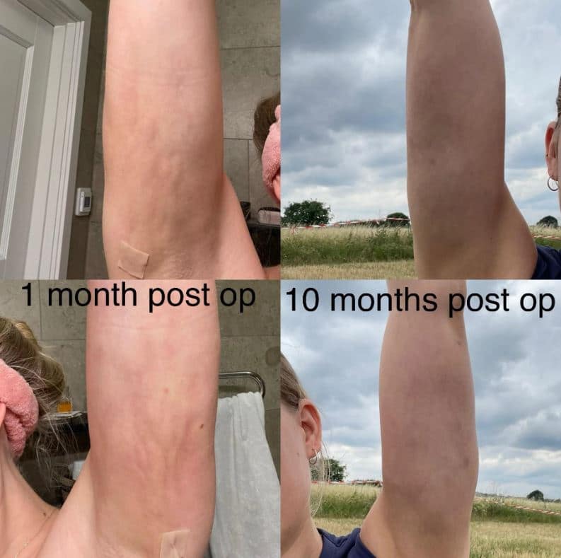 Arm Liposuction Review (10 months post-op) 5